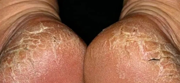 门徒平台登录：脚后跟总开裂起皮 不一定是干燥造成的！小心这几种病