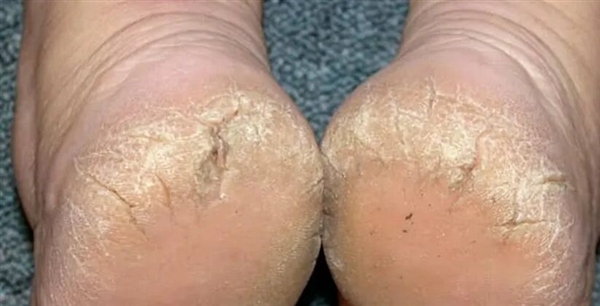 门徒平台登录：脚后跟总开裂起皮 不一定是干燥造成的！小心这几种病